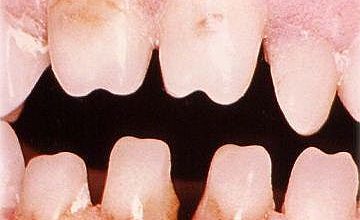 dentes de hutchinson