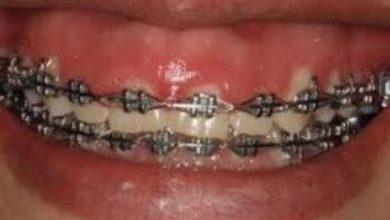 hiperplasia gengival