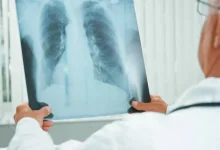 Descoberta de um medicamento inalável mais potente e eficaz contra a tuberculose, desenvolvido pela Unesp com apoio da nanotecnologia, que pode ser administrado por via inalatória e atinge diretamente as células infectadas.