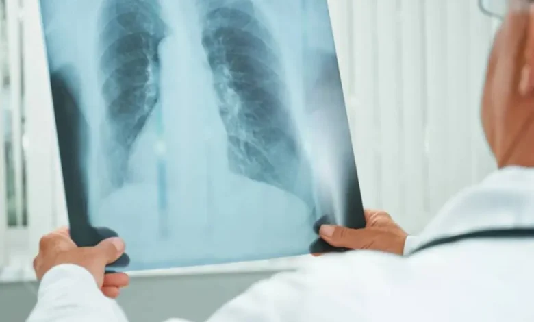 Descoberta de um medicamento inalável mais potente e eficaz contra a tuberculose, desenvolvido pela Unesp com apoio da nanotecnologia, que pode ser administrado por via inalatória e atinge diretamente as células infectadas.