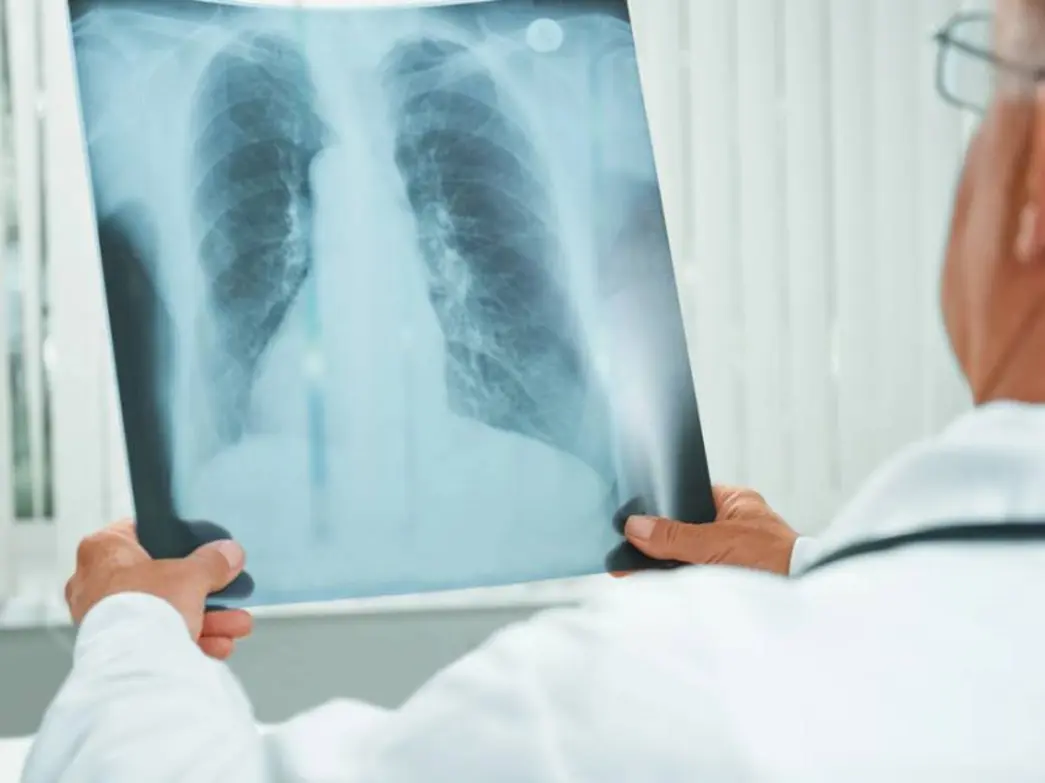 Descoberta de um medicamento inalável mais potente e eficaz contra a tuberculose, desenvolvido pela Unesp com apoio da nanotecnologia, que pode ser administrado por via inalatória e atinge diretamente as células infectadas.