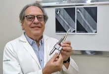 Haste intramedular revoluciona o tratamento de fraturas no fêmur, proporcionando maior precisão, recuperação rápida e menor invasividade. Pacientes se recuperam com mais agilidade e qualidade de vida, retornando às atividades cotidianas com mais segurança e conforto.