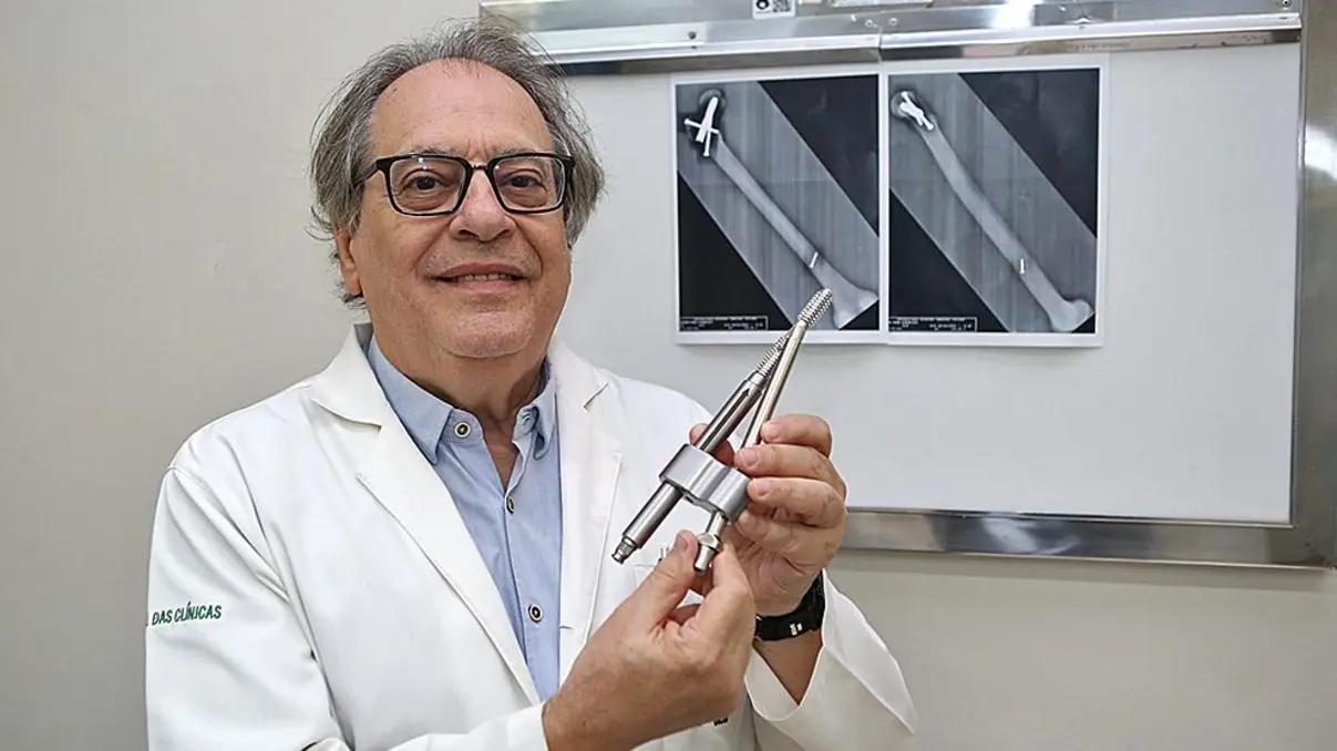 Haste intramedular revoluciona o tratamento de fraturas no fêmur, proporcionando maior precisão, recuperação rápida e menor invasividade. Pacientes se recuperam com mais agilidade e qualidade de vida, retornando às atividades cotidianas com mais segurança e conforto.