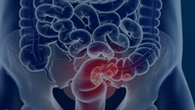 Câncer colorretal: Previsão alarmante de 36% aumento na mortalidade até 2040. Falta de detecção precoce é apontada como fator chave. Exames como teste de sangue oculto nas fezes e colonoscopia são cruciais para a prevenção. Saiba mais.