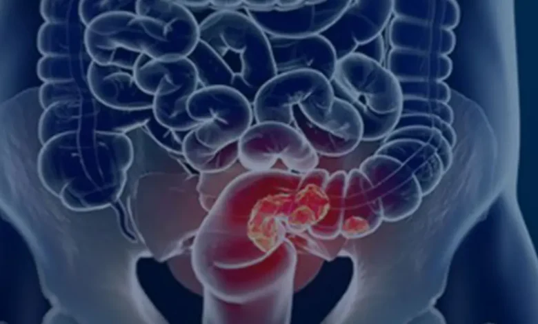 Câncer Colorretal: Mortalidade em Alta até 2040 1 Câncer colorretal: Previsão alarmante de 36% aumento na mortalidade até 2040. Falta de detecção precoce é apontada como fator chave. Exames como teste de sangue oculto nas fezes e colonoscopia são cruciais para a prevenção. Saiba mais.