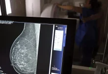 Detecção precoce do câncer de mama em mulheres jovens é um desafio complexo, principalmente em faixas etárias inferiores a 40 anos, onde a doença pode se apresentar em estágios avançados.