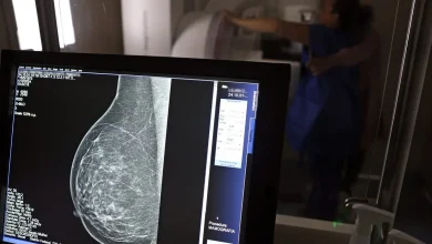 Detecção Precoce do Câncer de Mama em Mulheres Jovens é um Desafio Complexo 2 Detecção precoce do câncer de mama em mulheres jovens é um desafio complexo, principalmente em faixas etárias inferiores a 40 anos, onde a doença pode se apresentar em estágios avançados.