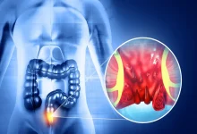 Esqueça a busca pelo 'culpado' na dieta. Entenda como o padrão alimentar e a hidratação são as chaves para prevenir e tratar hemorroidas de forma eficaz.