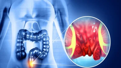 Esqueça a busca pelo 'culpado' na dieta. Entenda como o padrão alimentar e a hidratação são as chaves para prevenir e tratar hemorroidas de forma eficaz.