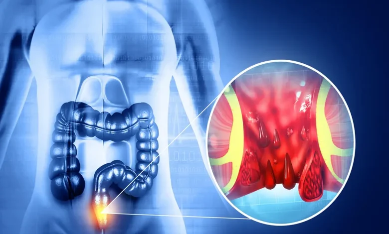 Esqueça a busca pelo 'culpado' na dieta. Entenda como o padrão alimentar e a hidratação são as chaves para prevenir e tratar hemorroidas de forma eficaz.