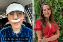 Descubra os perigos do PMMA em procedimentos estéticos faciais, como identificar complicações anos depois e quais são seus direitos como paciente. Um alerta da Folha de Paraguaçu.