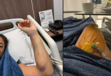 O Tromboembolismo Pulmonar pode ocorrer mesmo em viagens aéreas curtas. Entenda os sinais de alerta e como se prevenir para manter sua saúde em dia.