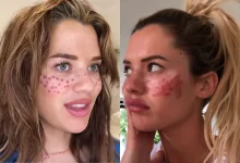 Uma influenciadora digital precisou ser hospitalizada após seguir uma trend de beleza viral. Conheça os riscos e o alerta sobre cuidados com procedimentos caseiros.