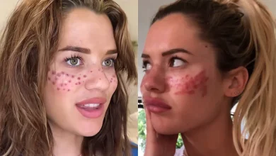Uma influenciadora digital precisou ser hospitalizada após seguir uma trend de beleza viral. Conheça os riscos e o alerta sobre cuidados com procedimentos caseiros.