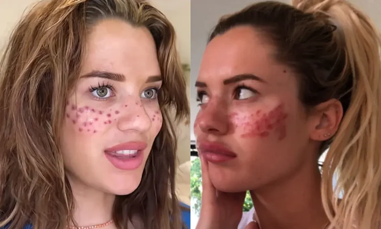 Uma influenciadora digital precisou ser hospitalizada após seguir uma trend de beleza viral. Conheça os riscos e o alerta sobre cuidados com procedimentos caseiros.