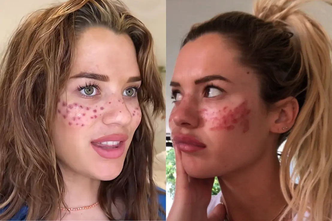 Uma influenciadora digital precisou ser hospitalizada após seguir uma trend de beleza viral. Conheça os riscos e o alerta sobre cuidados com procedimentos caseiros.