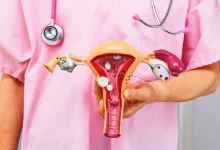 A ANS determinou que operadoras de planos de saúde cubram o DIU hormonal para o tratamento da endometriose. Confira os detalhes desta mudança.