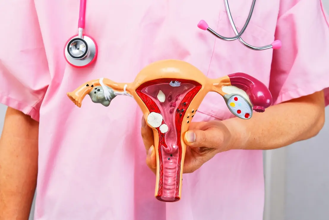 Planos de saúde devem cobrir DIU hormonal para endometriose 6 A ANS determinou que operadoras de planos de saúde cubram o DIU hormonal para o tratamento da endometriose. Confira os detalhes desta mudança.