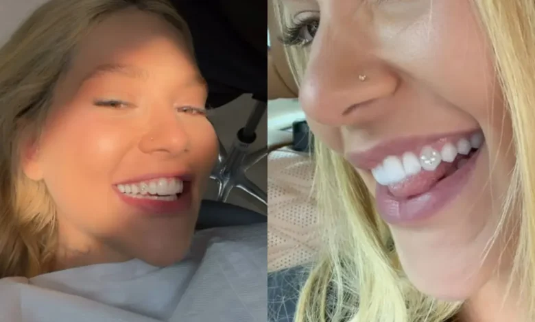 A moda de aplicar joias nos dentes ganhou força com influenciadores, mas especialistas alertam para riscos de cáries, infiltrações e danos ao esmalte dental.