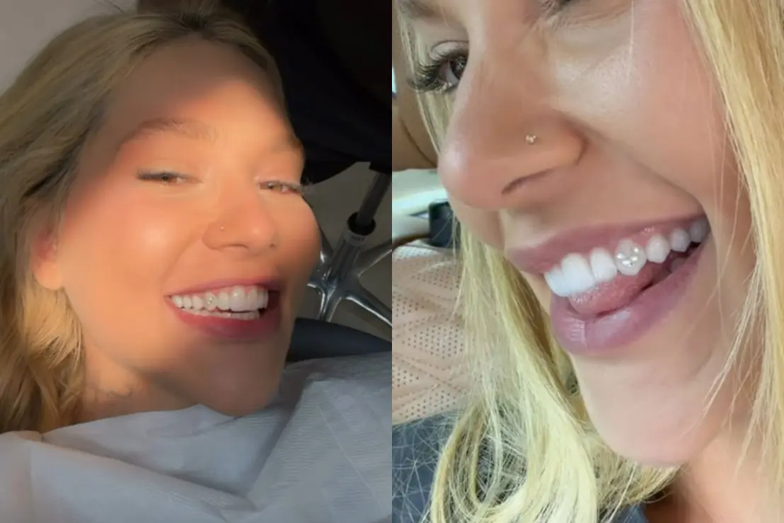 A moda de aplicar joias nos dentes ganhou força com influenciadores, mas especialistas alertam para riscos de cáries, infiltrações e danos ao esmalte dental.